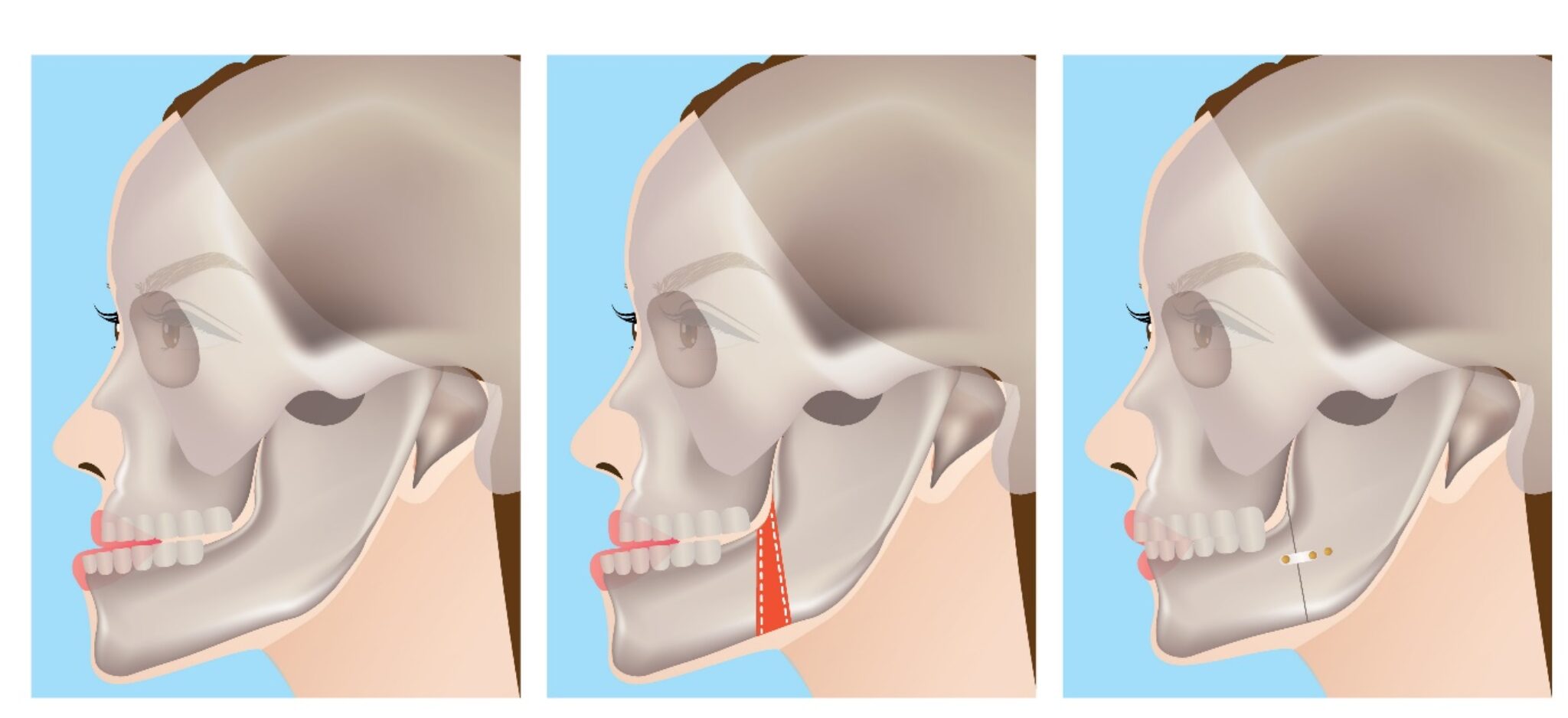 do-i-need-jaw-surgery-orthodontic-society-of-ireland